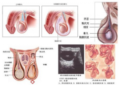 如何治疗鞘膜积液?